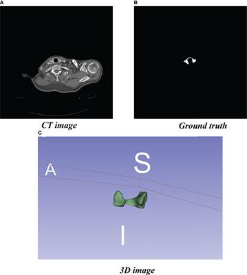 Application of Multi-Scale Fusion Attention U-Net to Segment the Thyroid Gland on Localized Computed Tomography Images for Radiotherapy